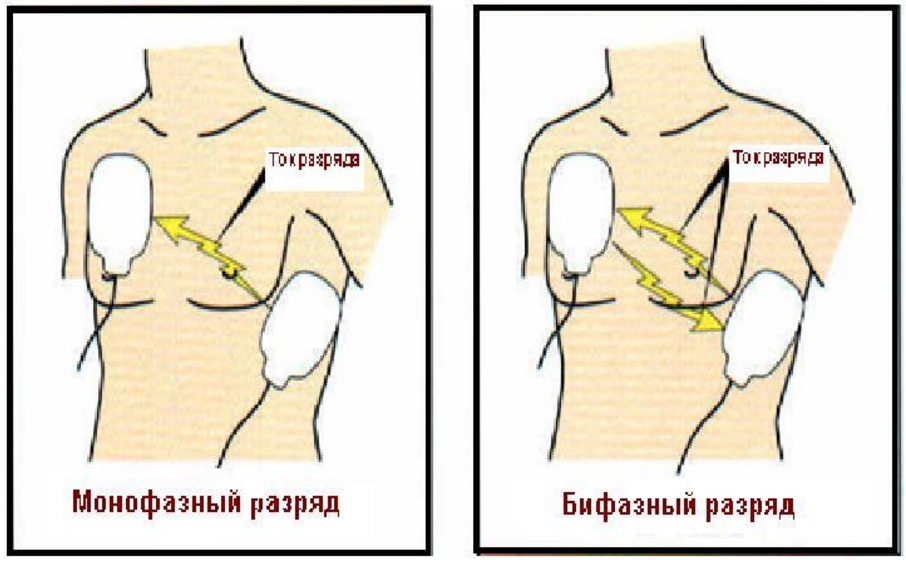 Моно-, биполярный разряд 